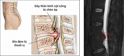 Thoát vị đĩa đệm