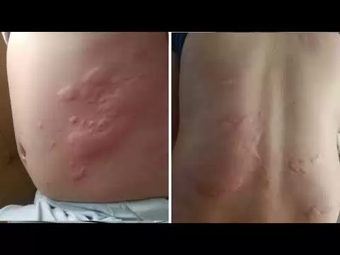 Bị nổi mề đay liên tục, có thuốc trị nổi mề đay khỏi hẳn