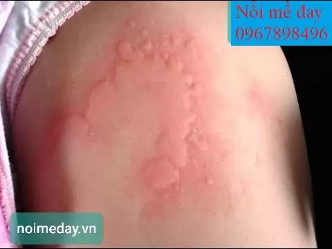 Cách trị bệnh mề đay tận gốc bằng thuốc đông y