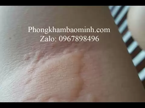 Nổi mề đay khám ở đâu