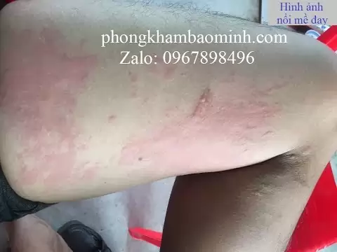 Nổi mề đay, mề đay dị ứng, bệnh mày đay, là gì