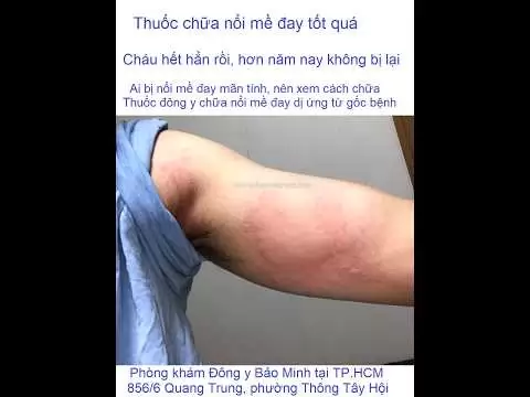 Thuốc bắc trị mề đay hay thuốc nam trị mề đay tốt hơn