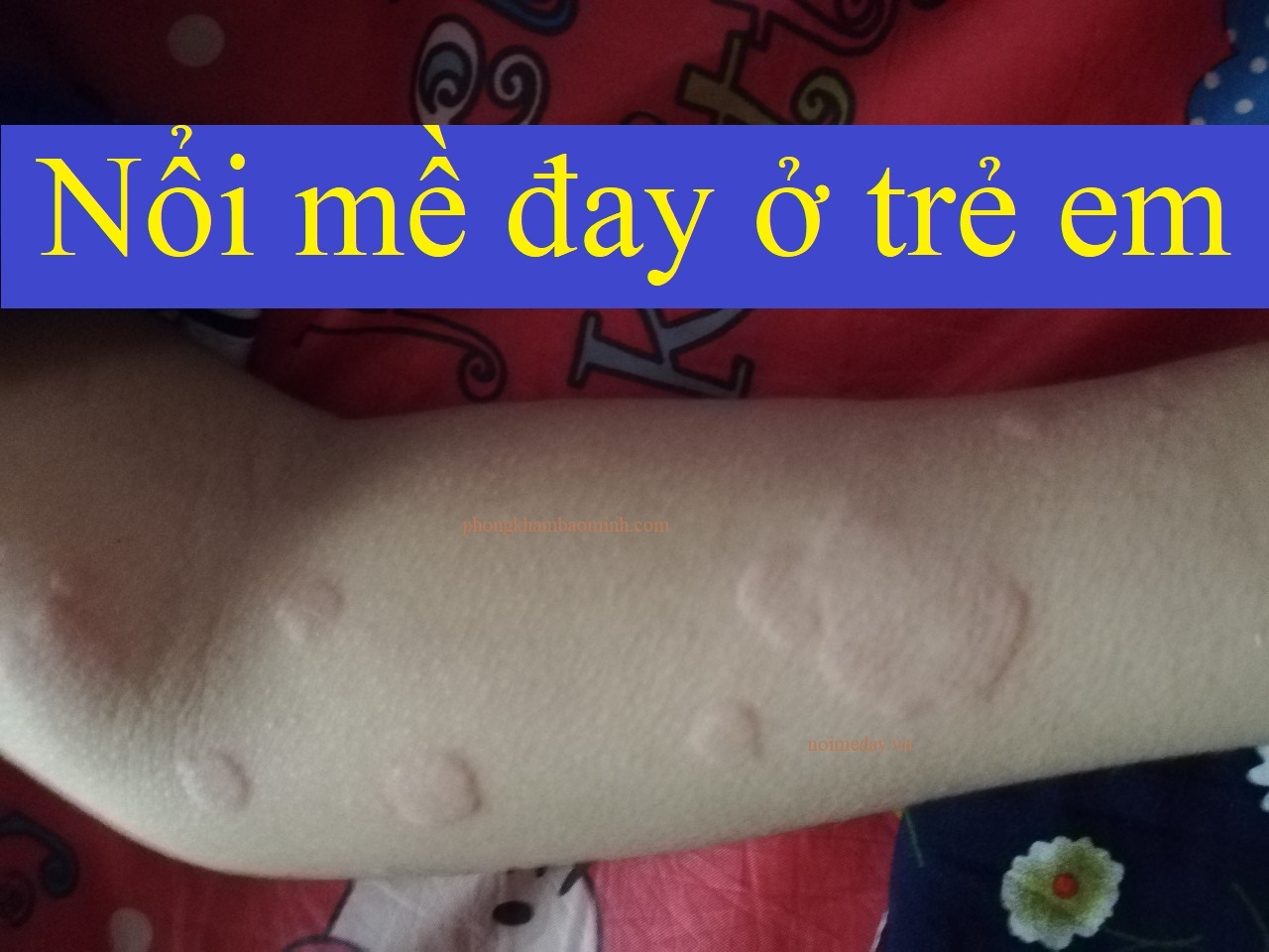 Nổi mề đay ở trẻ em