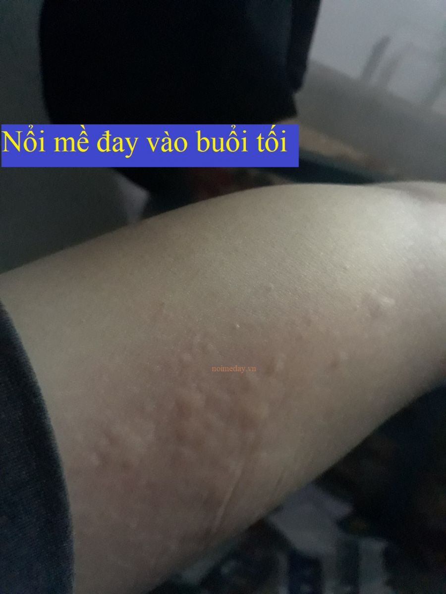 Nổi mề đay vào buổi tối