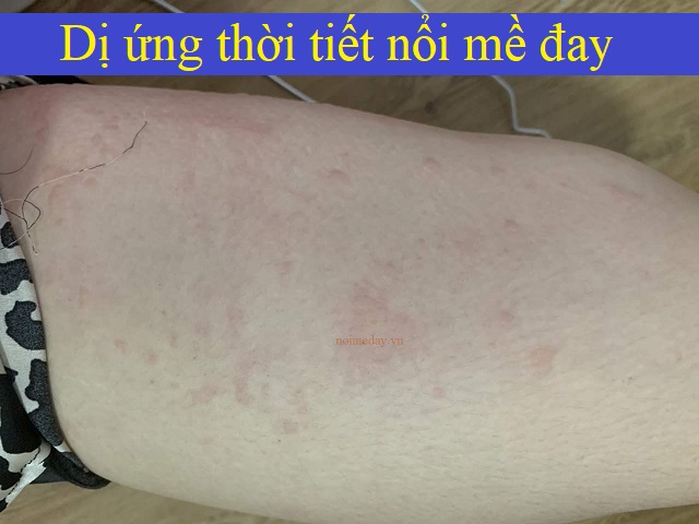 Dị ứng thời tiết