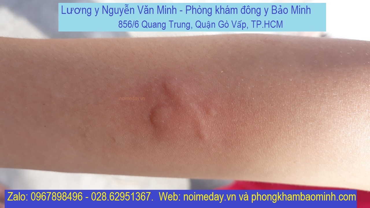 Nổi mề đay kiêng gì